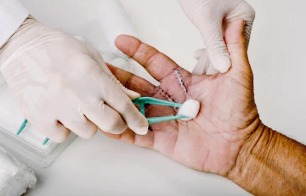 ablation sutures
